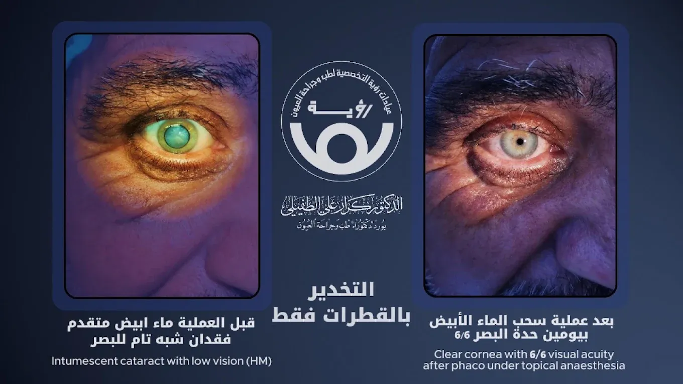 حالة ماء أبيض متقدم قبل العملية، وصفاء العين بعد سحب الماء الأبيض بيومين